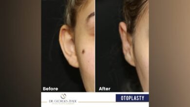 صورة توضيحية - جورج زيادة موضحاً لعملية رأب الأذن/ Otoplasty